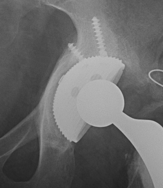 THR Intraoperative Acetabular Fracture